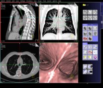 What is a CT Scan?